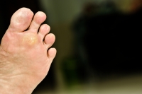 Plantar Warts Come From a Virus